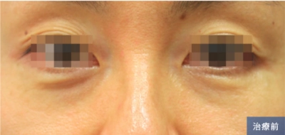 Before treatment