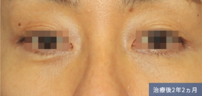 2 and a half years after the treatment