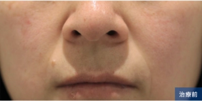 Before treatment