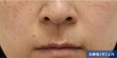 1 year and 2 months after the treatment