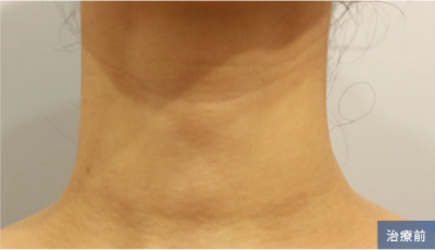 Before treatment