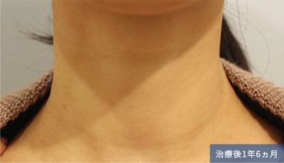 1 year and 6 months after the treatment