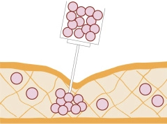 Inject the cultured cells into skin