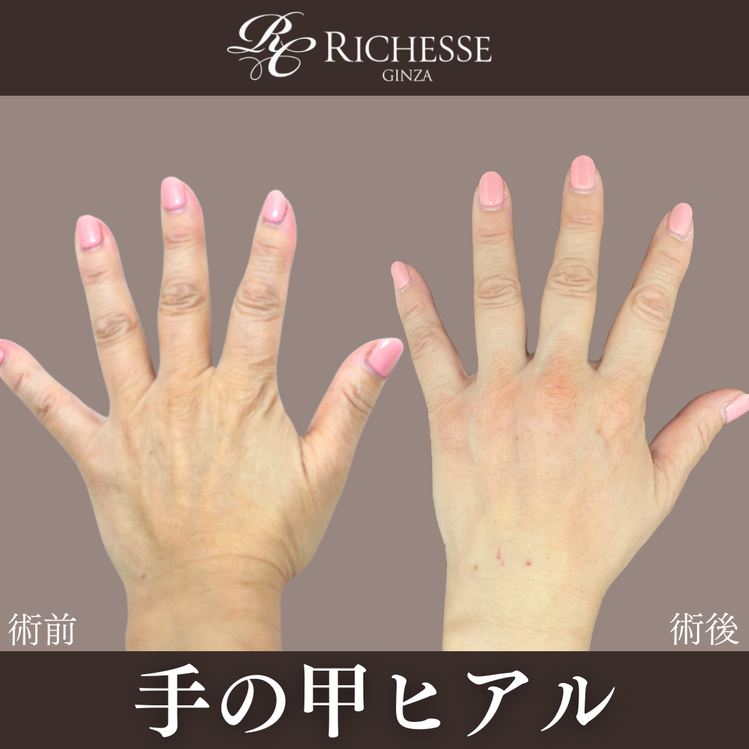 手の甲ヒアルロン酸