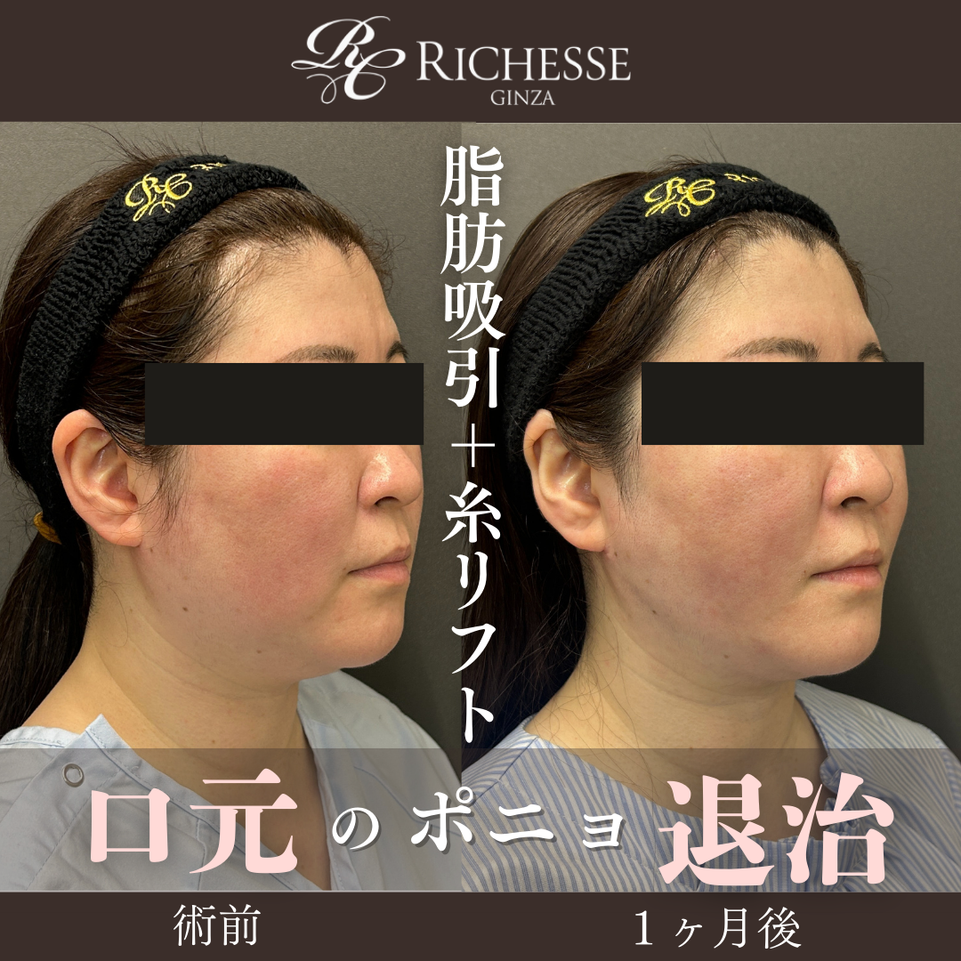 脂肪吸引＋糸リフトで口横のボリュームを減らす‼️