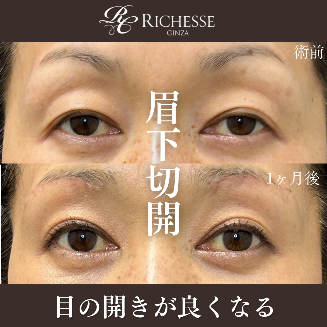 眉下切開で目の開きを改善✨