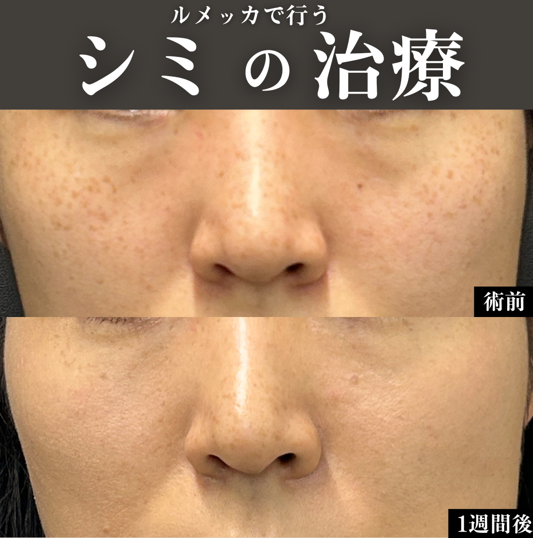 ルメッカでシミ取り