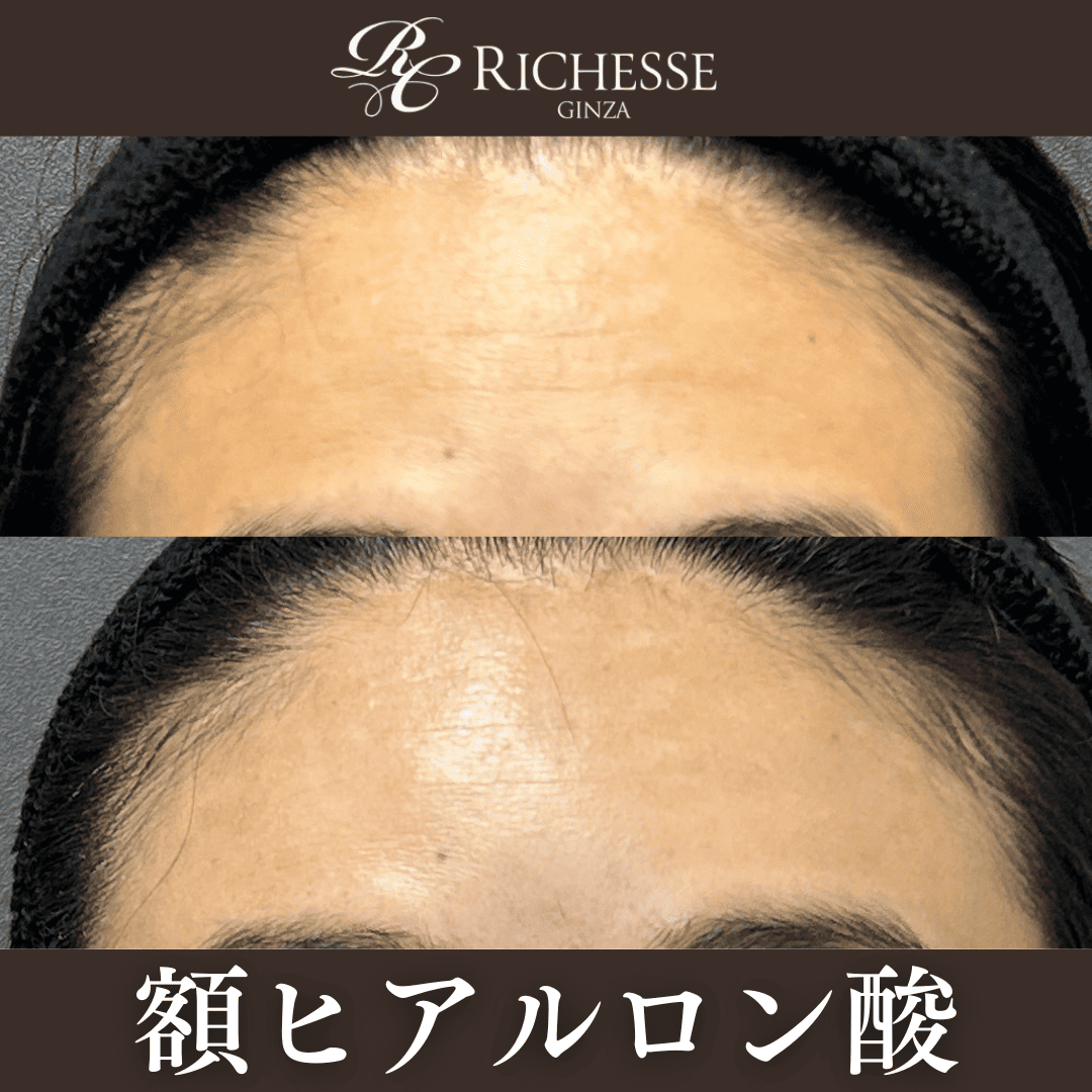 額ヒアルロン酸