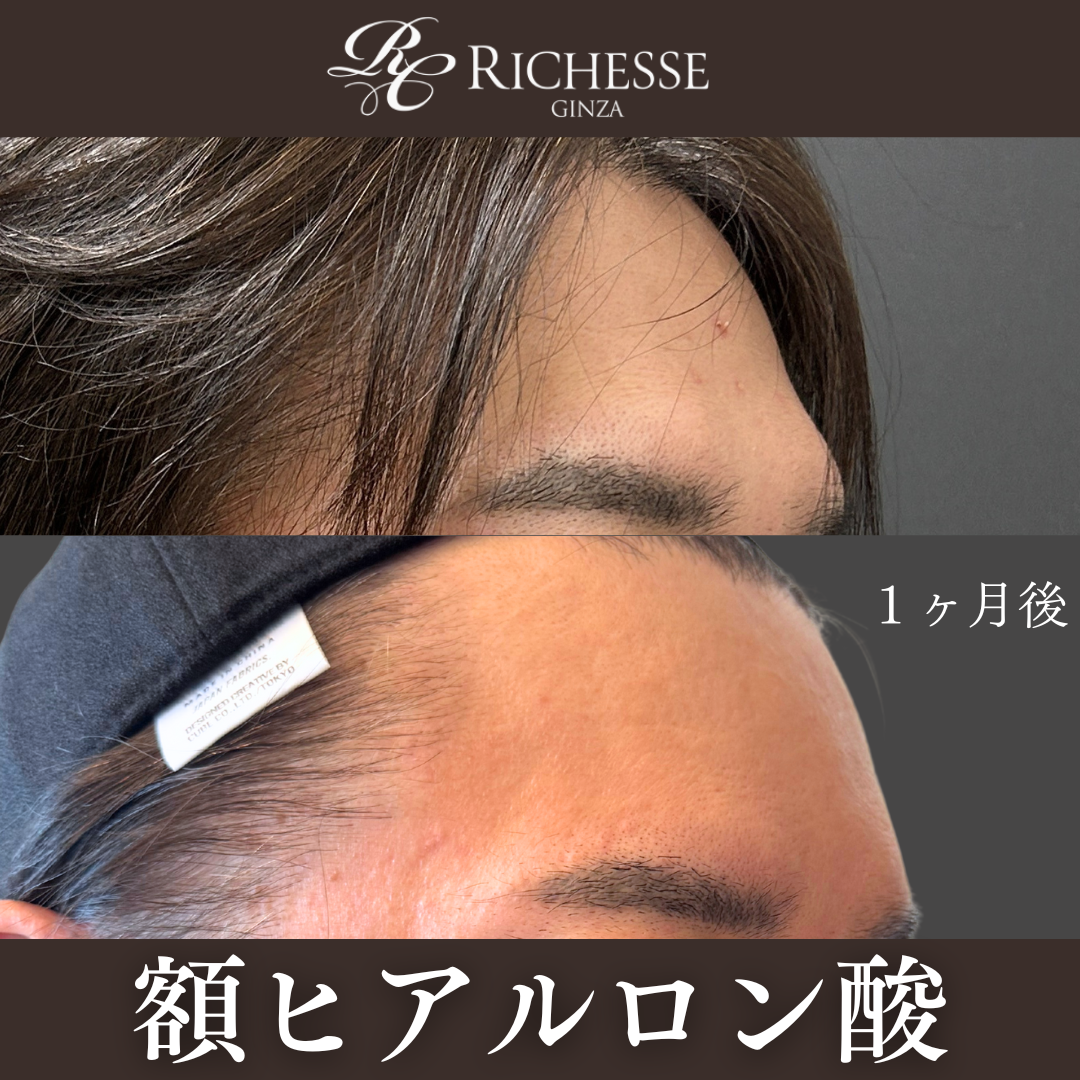 男性のおでこヒアルロン酸