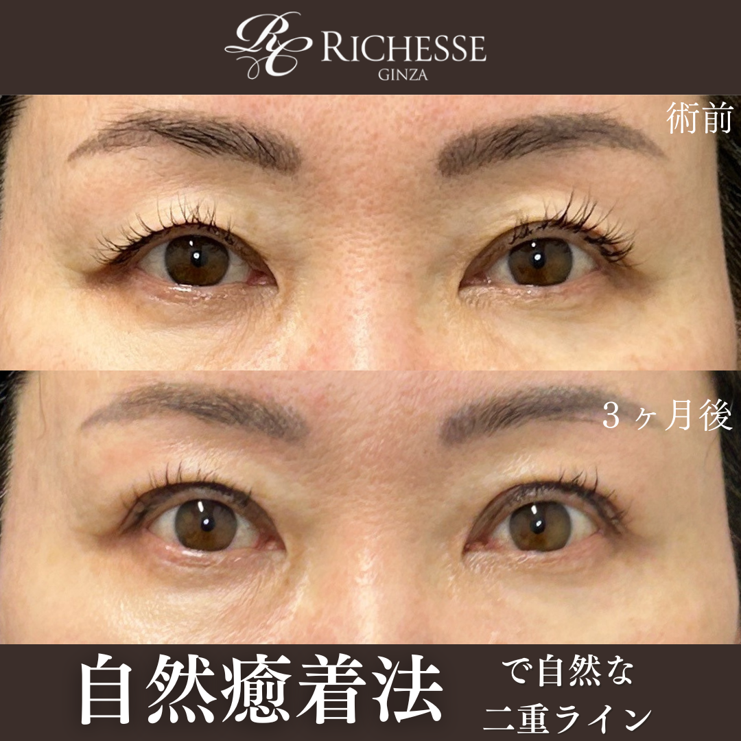 二重自然癒着法