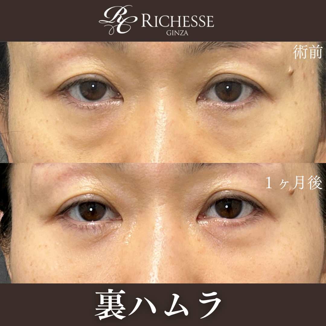 裏ハムラ法