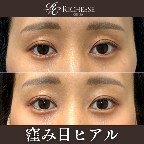 窪み目ヒアル