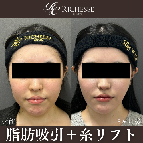 脂肪吸引＋糸リフト