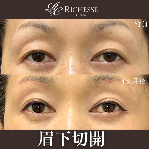 眉下切開で目の開きを改善