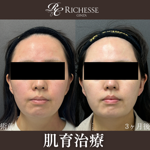 肌育治療