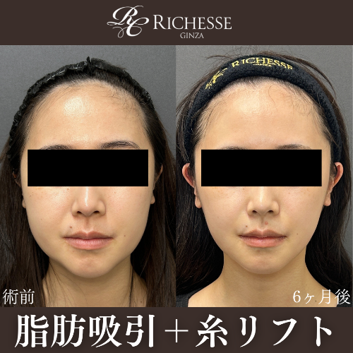 脂肪吸引＋糸リフト