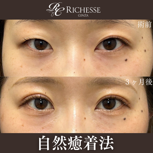 【左右差改善】自然癒着法