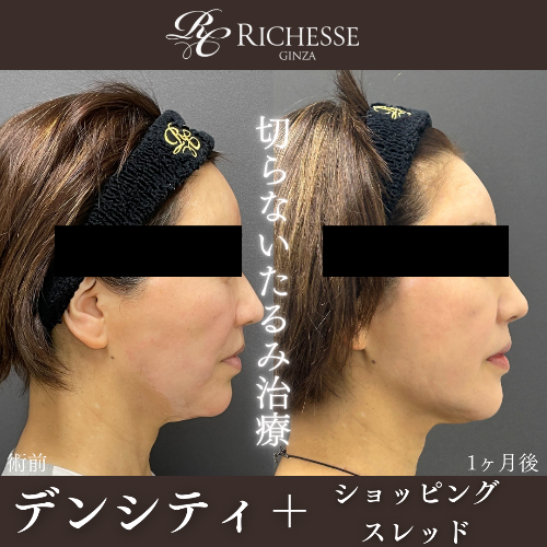 切らないたるみ治療