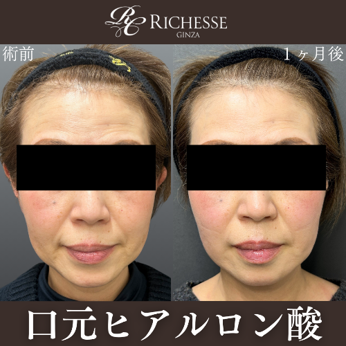 ヒアルロン酸によるたるみ治療