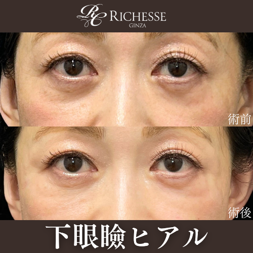 下眼瞼ヒアルロン酸
