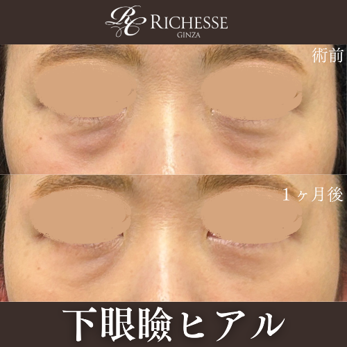 ヒアルロン酸でクマ改善‼️