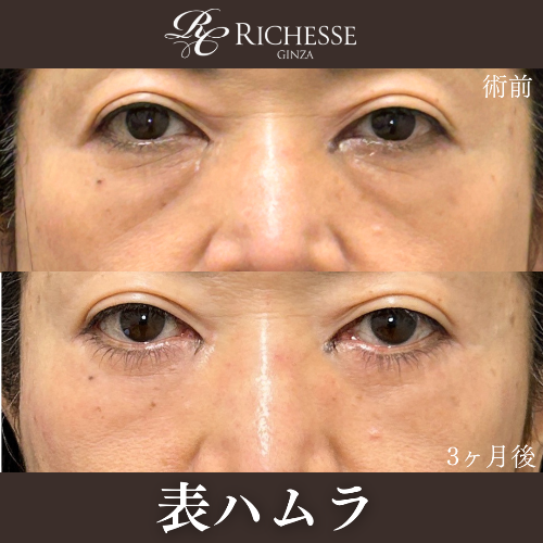 表ハムラ法の経過