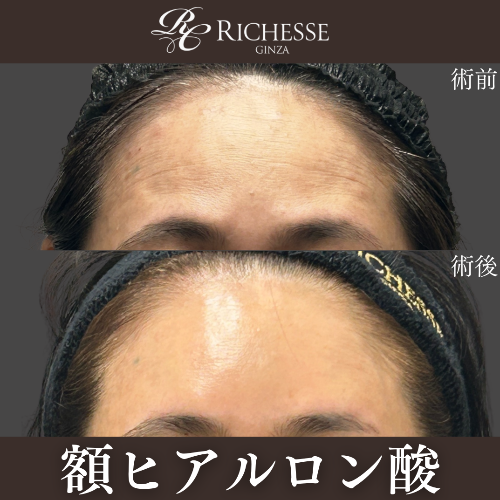 額ヒアルロン酸