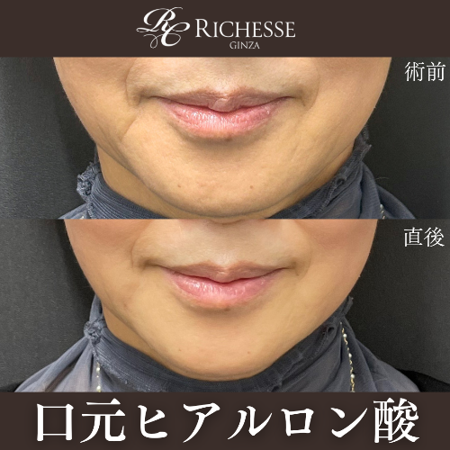 口元ヒアルロン酸