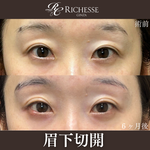眉下切開の経過