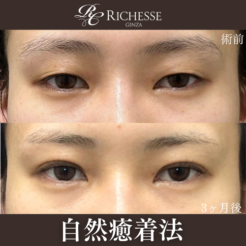 二重自然癒着法の経過