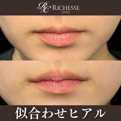 唇ヒアルロン酸