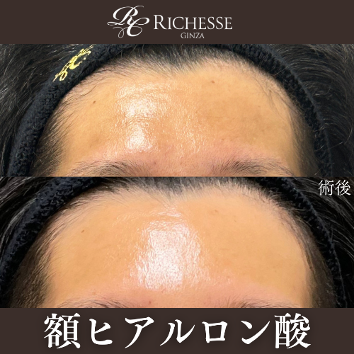 額ヒアルロン酸
