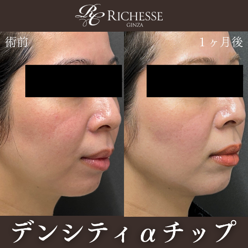 デンシティαチップ